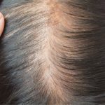 womens-hair-thinning-identifying-triggers-and-effective-solutions